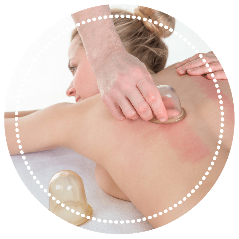 om physiotherapy, Cupping Therapy